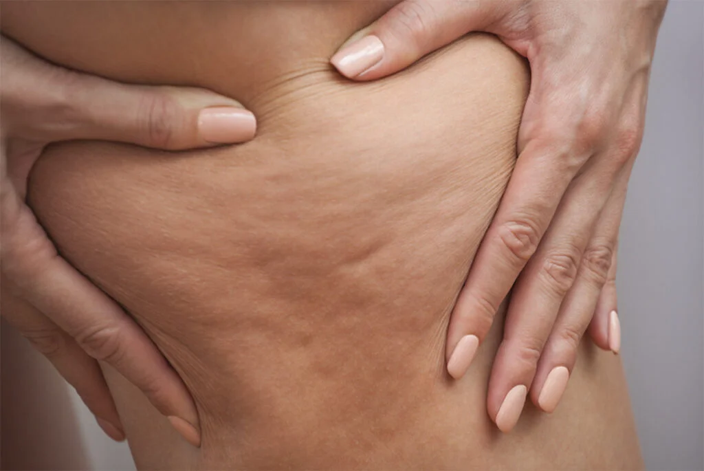 La Cellulite ! Mieux la comprendre pour mieux la traiter.